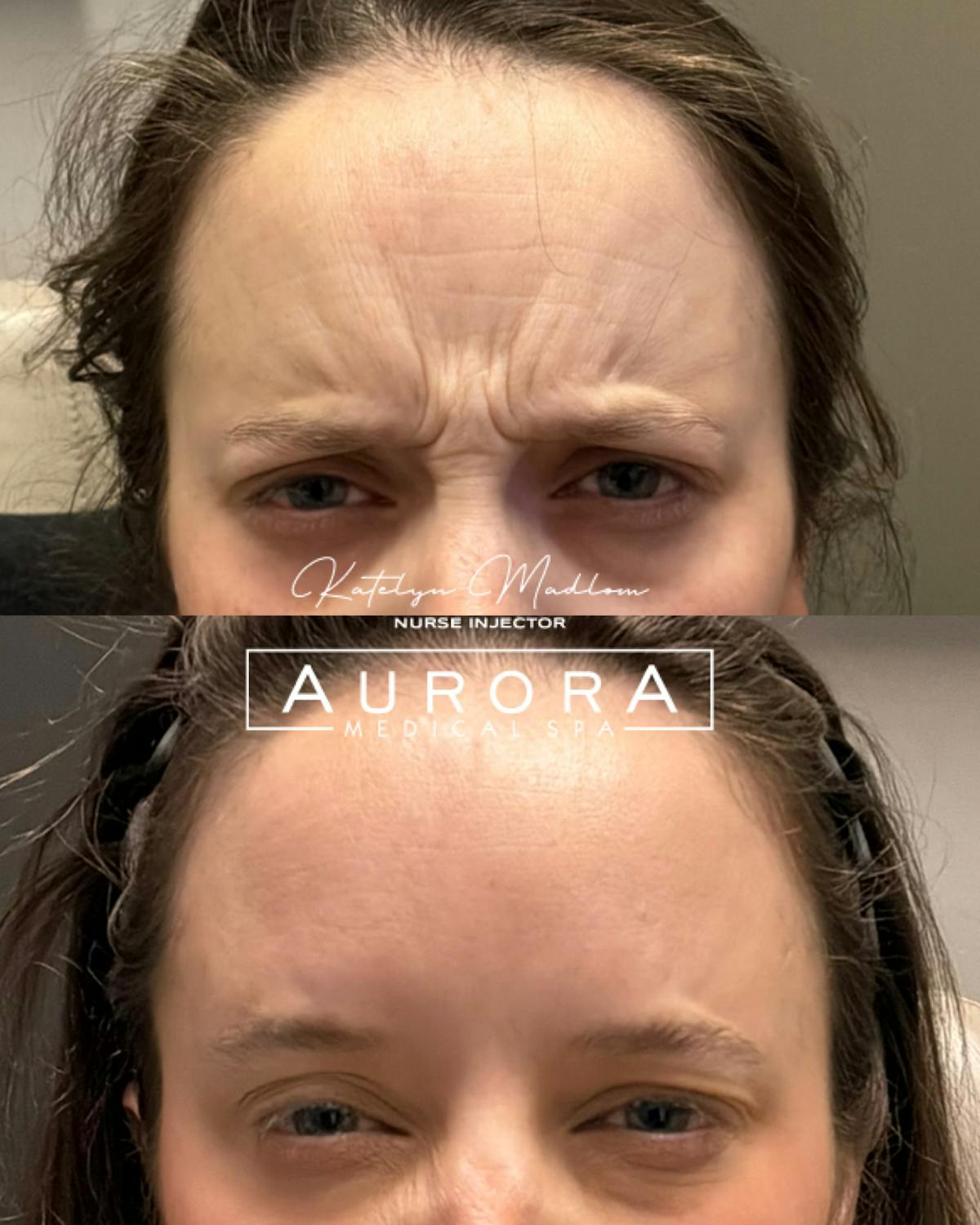 BOTOX Before & After Gallery - Patient 923514 - Image 3