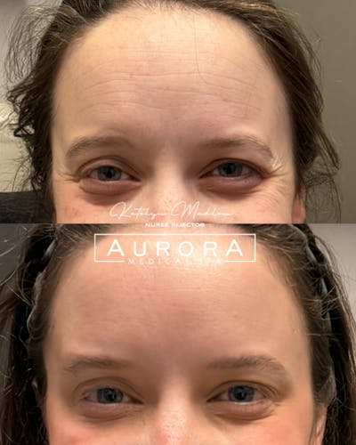 BOTOX Before & After Gallery - Patient 923514 - Image 1
