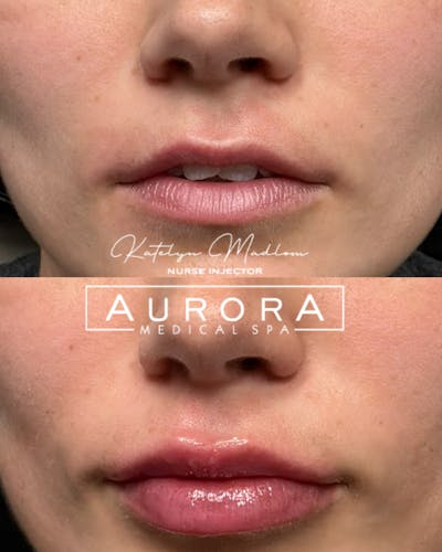 Lip Filler Before & After Gallery - Patient 314134 - Image 1