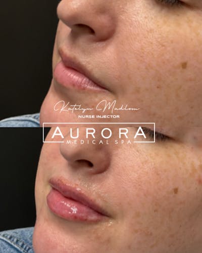 Lip Filler Before & After Gallery - Patient 142107 - Image 1