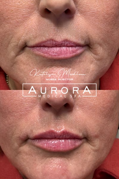 Lip Filler Before & After Gallery - Patient 349145 - Image 1