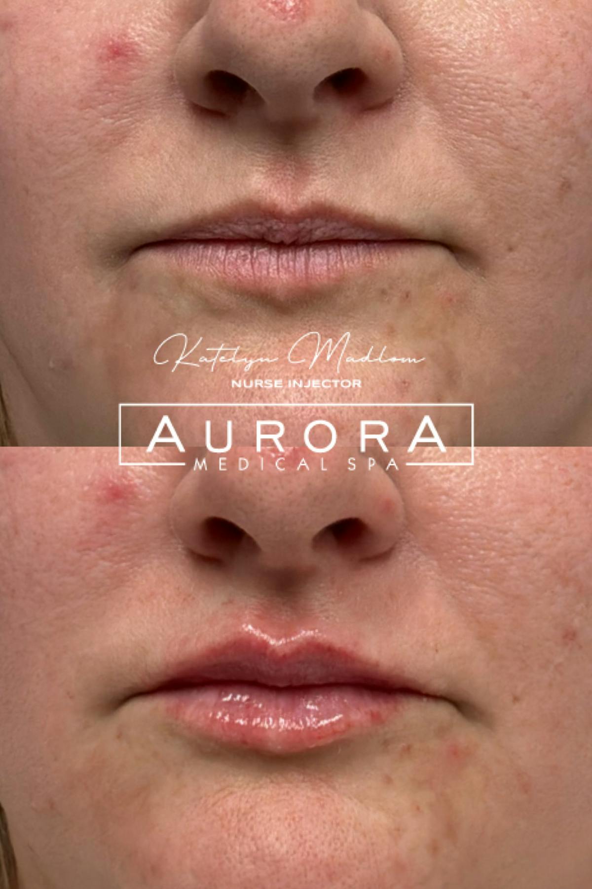 Lip Filler Before & After Gallery - Patient 282899 - Image 1