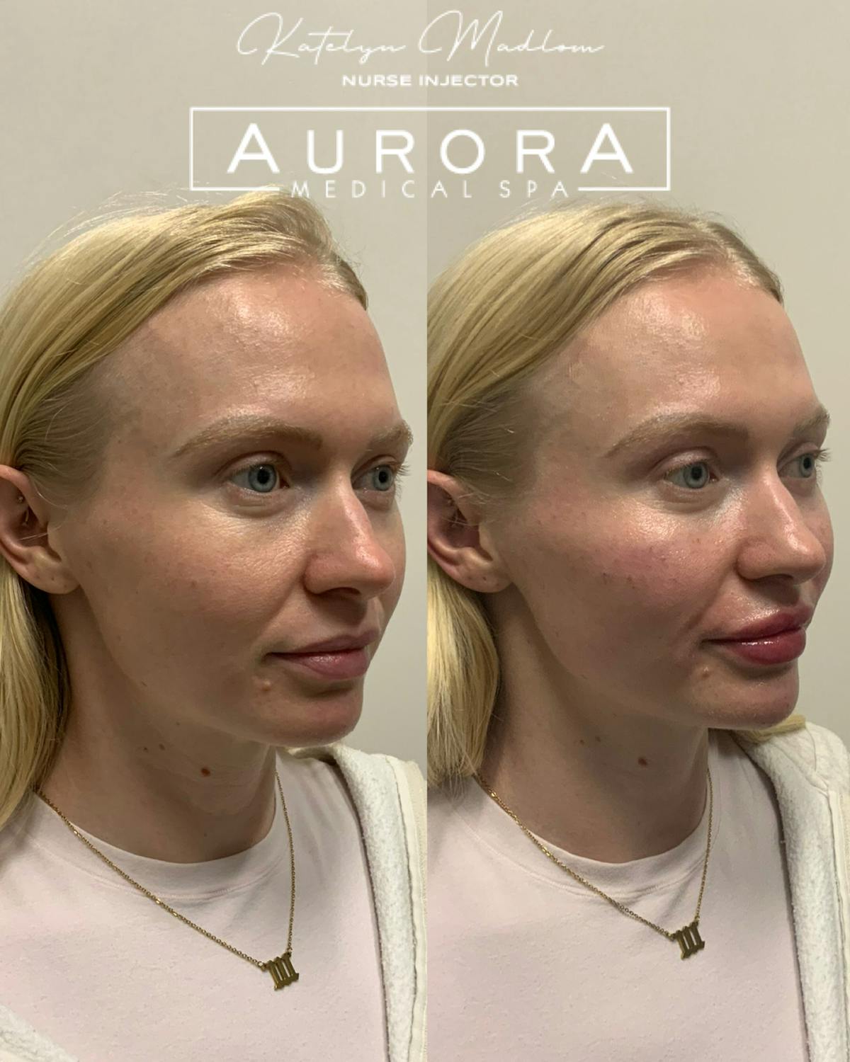 Lip Filler Before & After Gallery - Patient 170354 - Image 1