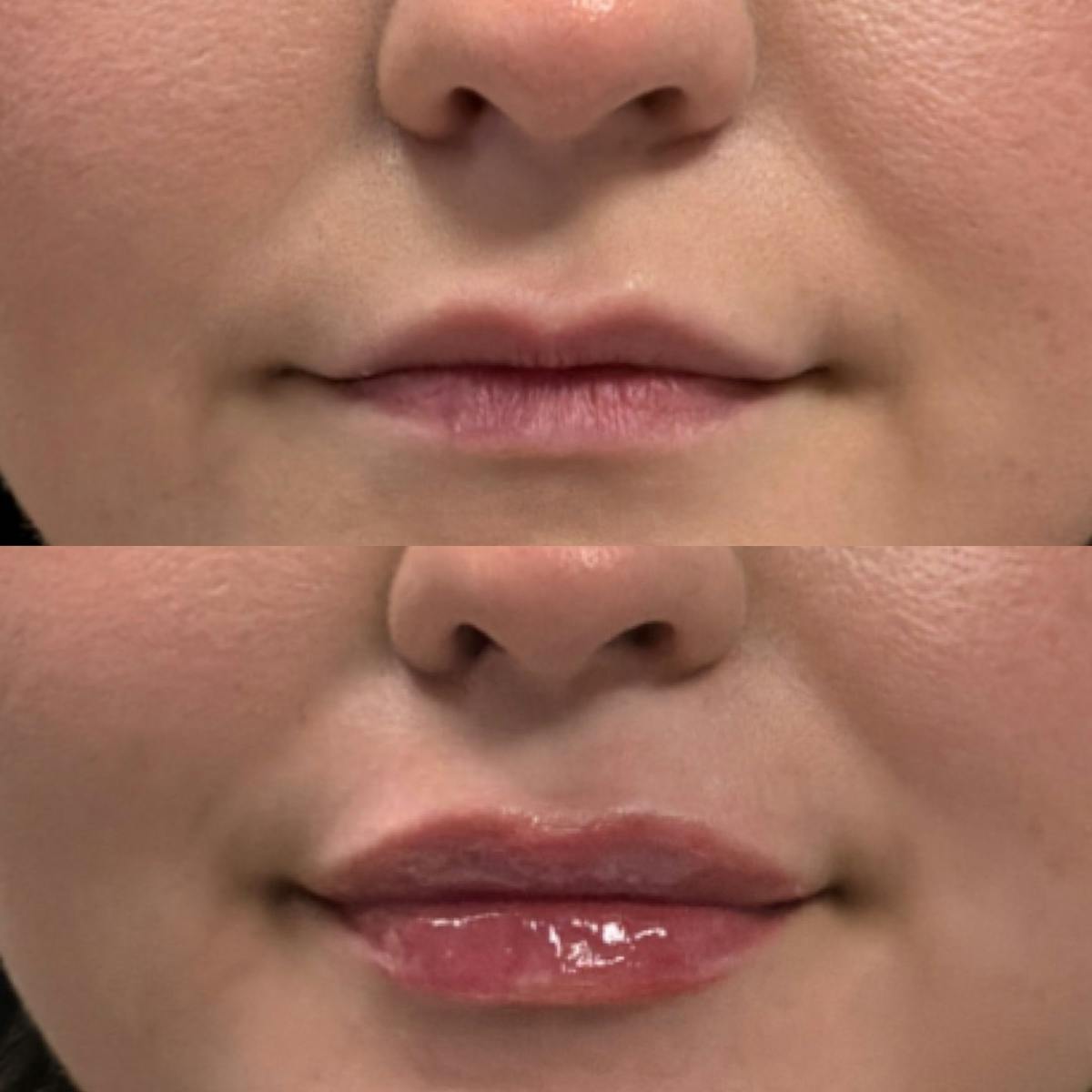 Lip Filler Before & After Gallery - Patient 709476 - Image 1