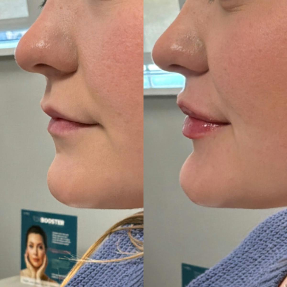 Lip Filler Before & After Gallery - Patient 709476 - Image 3