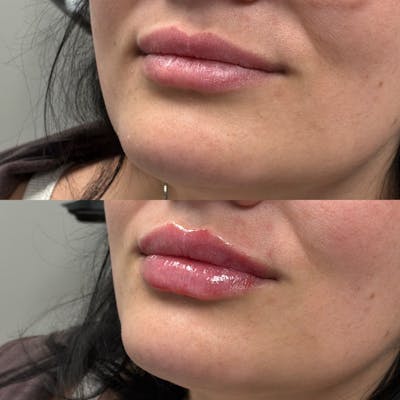 Lip Filler Before & After Gallery - Patient 240698 - Image 1