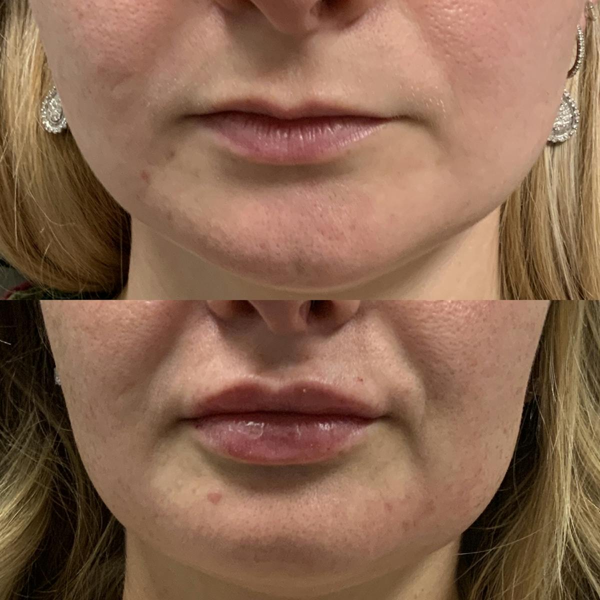 Lip Filler Before & After Gallery - Patient 766876 - Image 1