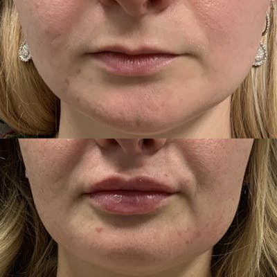Lip Filler Before & After Gallery - Patient 766876 - Image 1