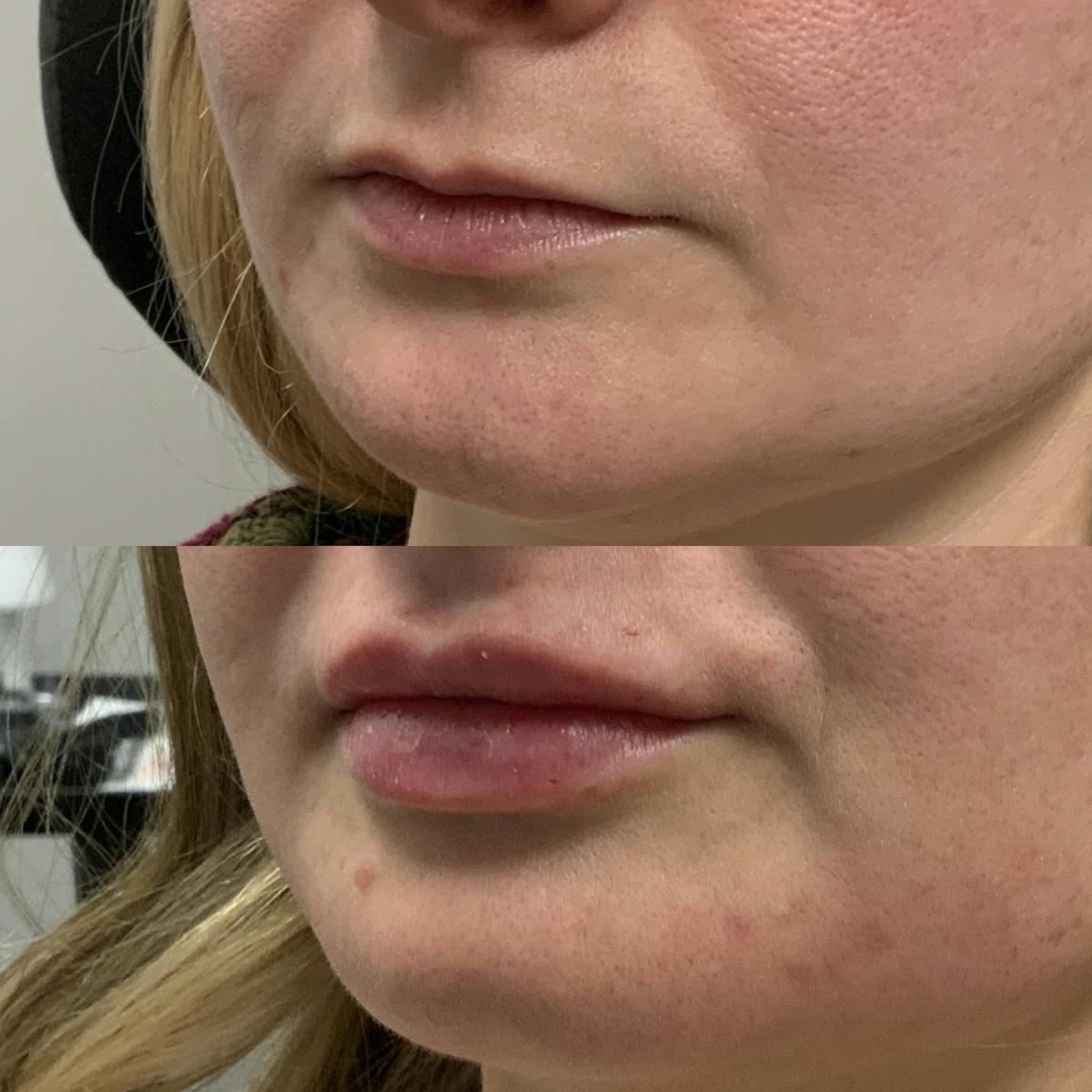 Lip Filler Before & After Gallery - Patient 766876 - Image 2
