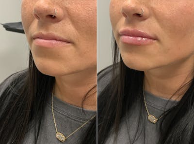 Lip Filler Before & After Gallery - Patient 186664 - Image 1
