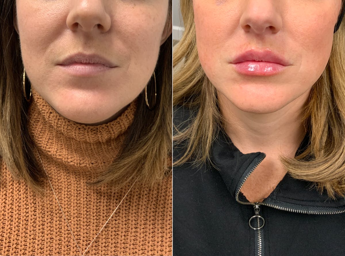 Lip Filler Before & After Gallery - Patient 232594 - Image 1