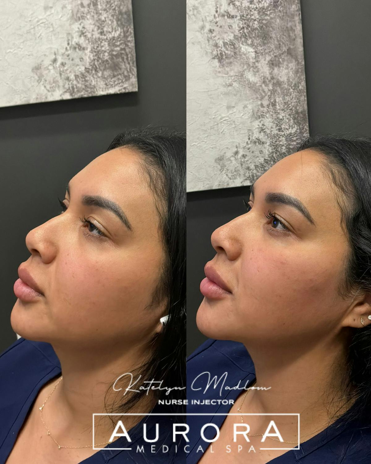 Facial Balancing Before & After Gallery - Patient 155888 - Image 1