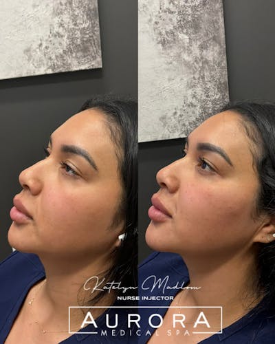 Facial Balancing Before & After Gallery - Patient 155888 - Image 1
