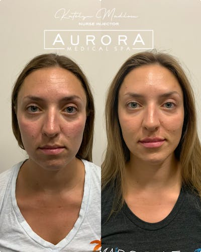 Facial Balancing Before & After Gallery - Patient 427111 - Image 1