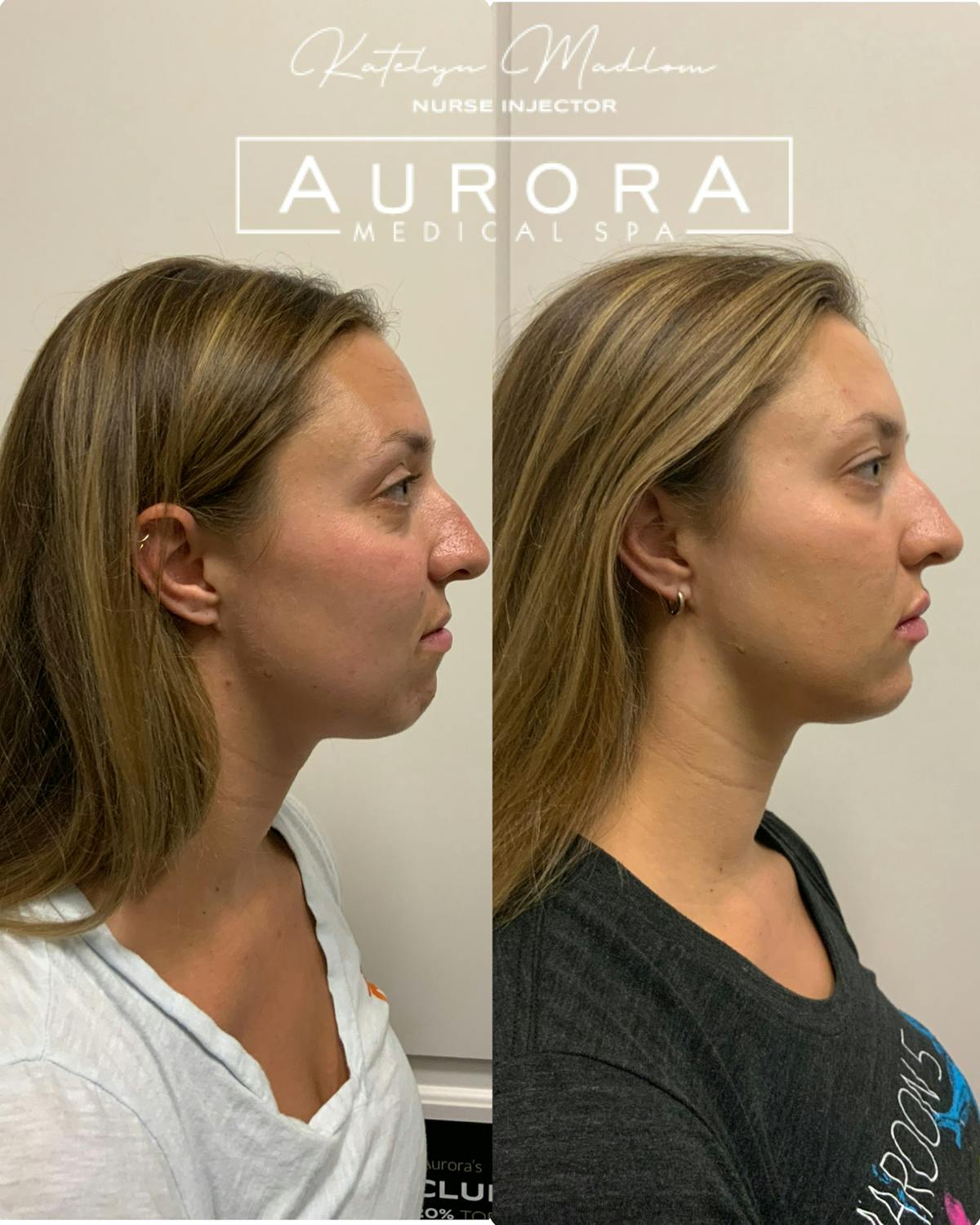 Facial Balancing Before & After Gallery - Patient 427111 - Image 2