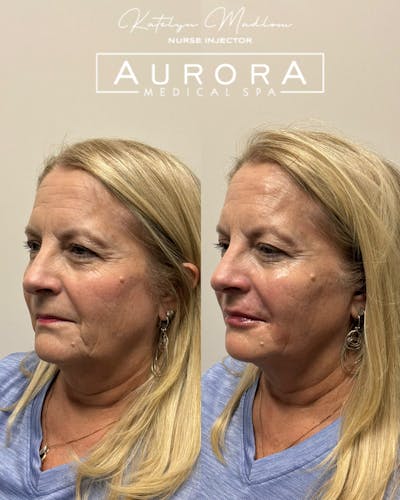 Lip Filler Before & After Gallery - Patient 198494 - Image 1