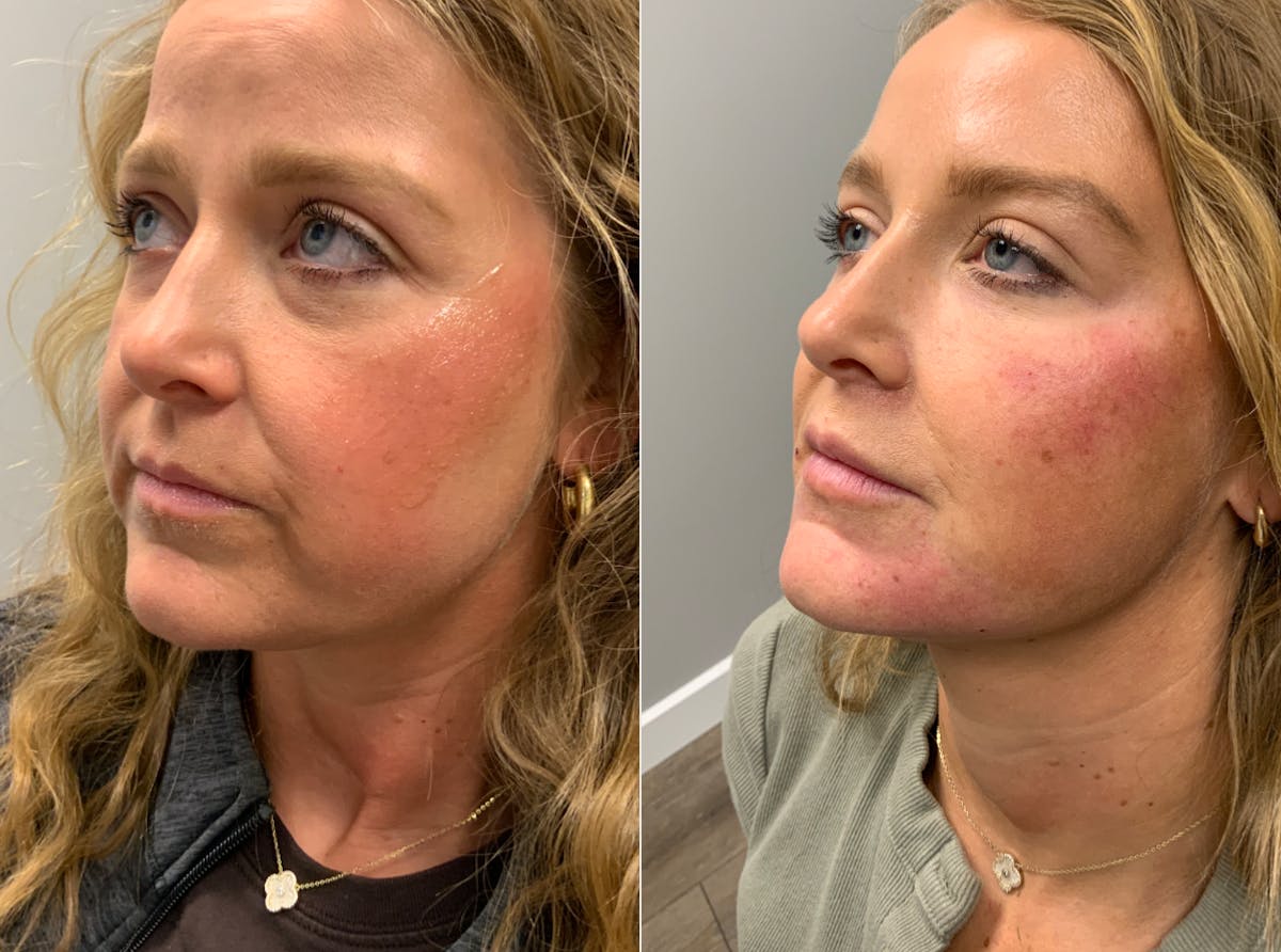 Facial Balancing Before & After Gallery - Patient 361223 - Image 1