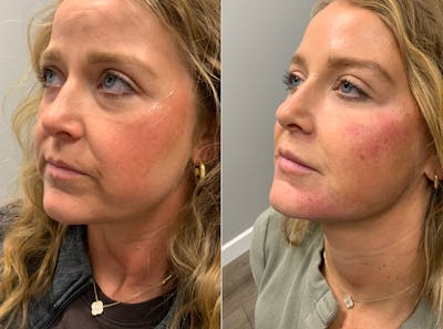 Facial Balancing Before & After Gallery - Patient 361223 - Image 1