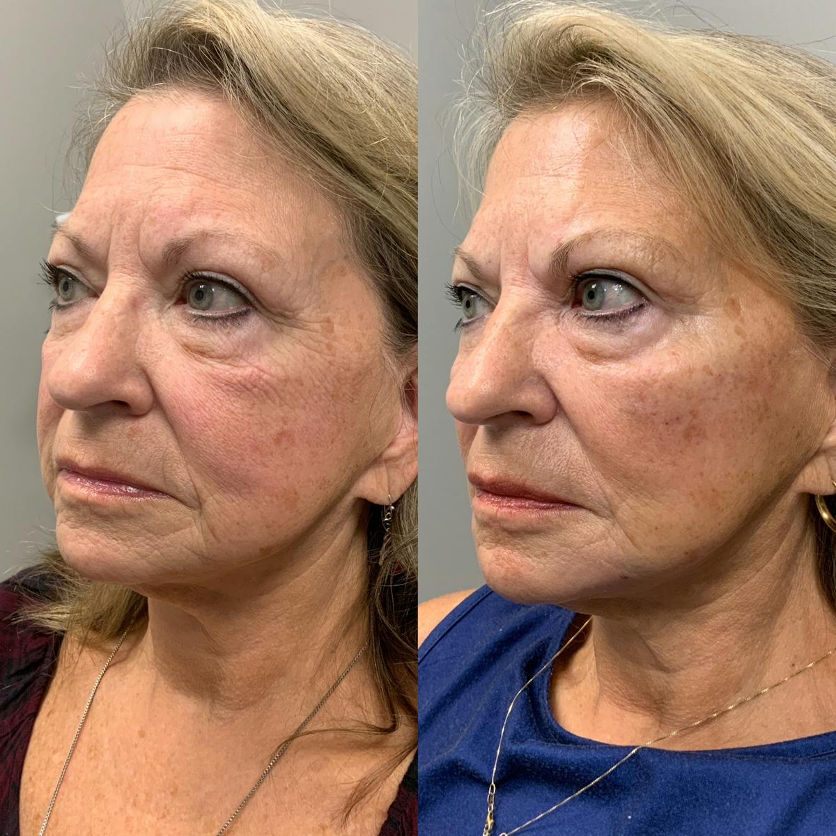 Facial Balancing Before & After Gallery - Patient 213927 - Image 1