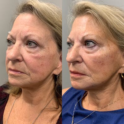Facial Balancing Before & After Gallery - Patient 213927 - Image 1