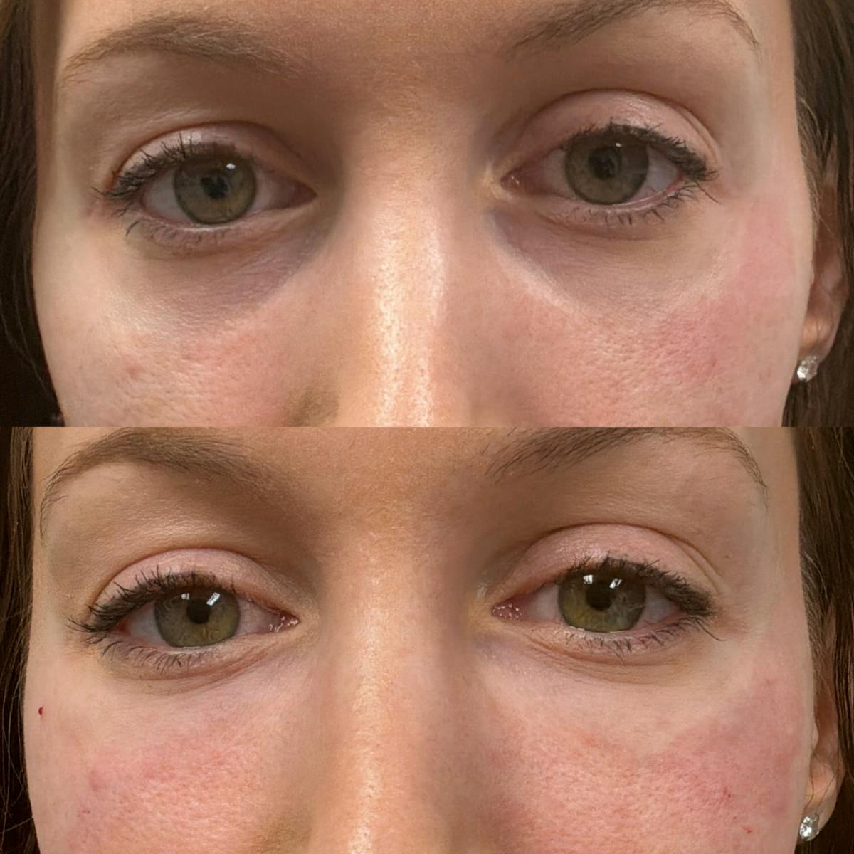 Facial Balancing Before & After Gallery - Patient 319213 - Image 1