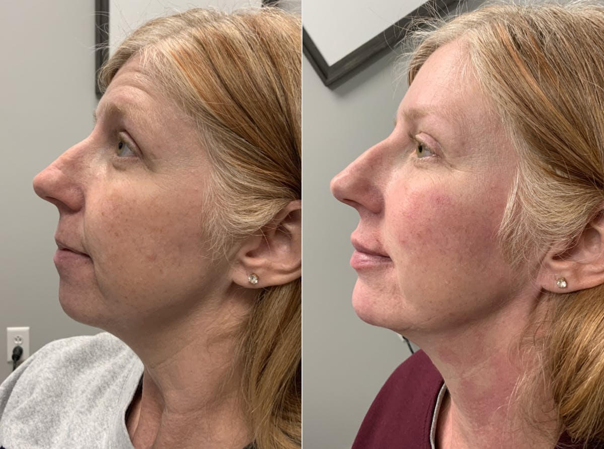 Facial Balancing Before & After Gallery - Patient 307327 - Image 2
