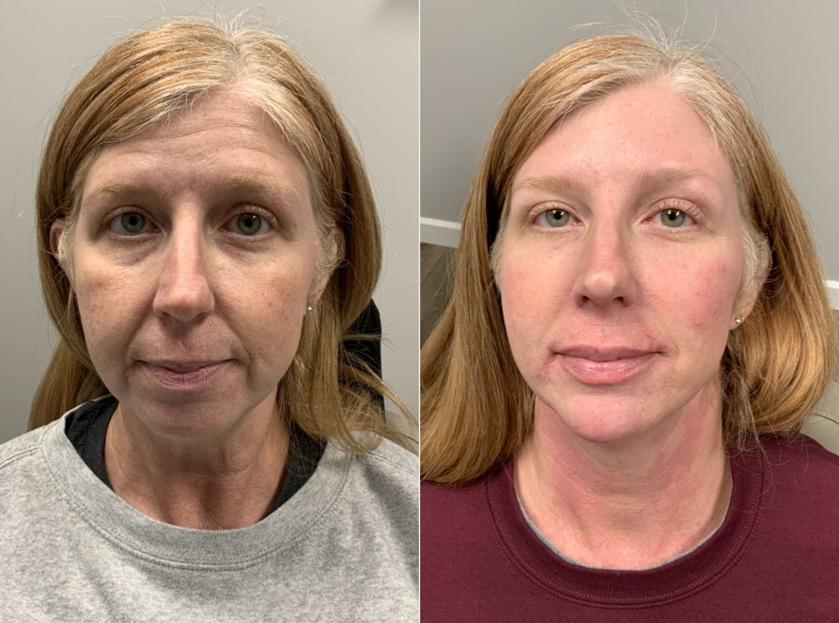 Facial Balancing Before & After Gallery - Patient 307327 - Image 1
