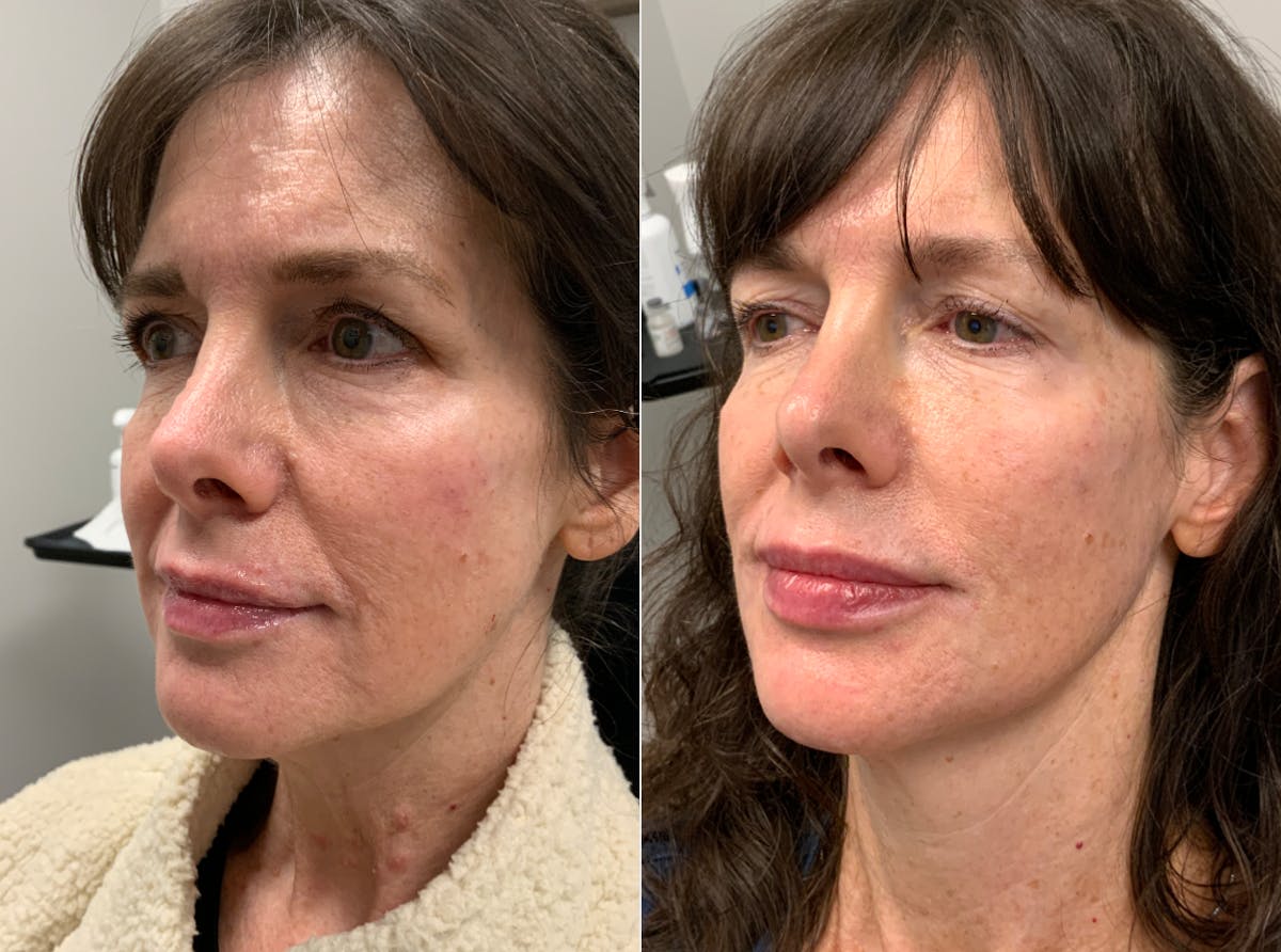 Facial Balancing Before & After Gallery - Patient 234580 - Image 2