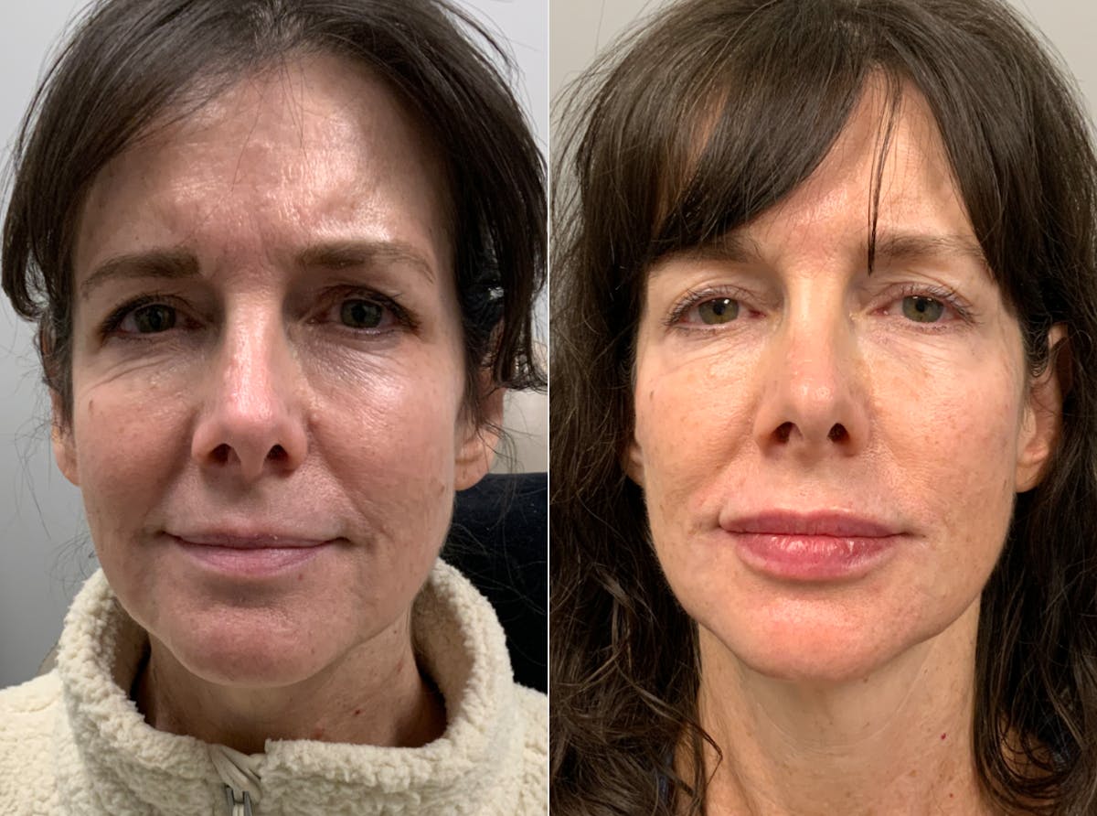 Facial Balancing Before & After Gallery - Patient 234580 - Image 1