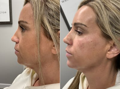 Facial Balancing Before & After Gallery - Patient 895578 - Image 1
