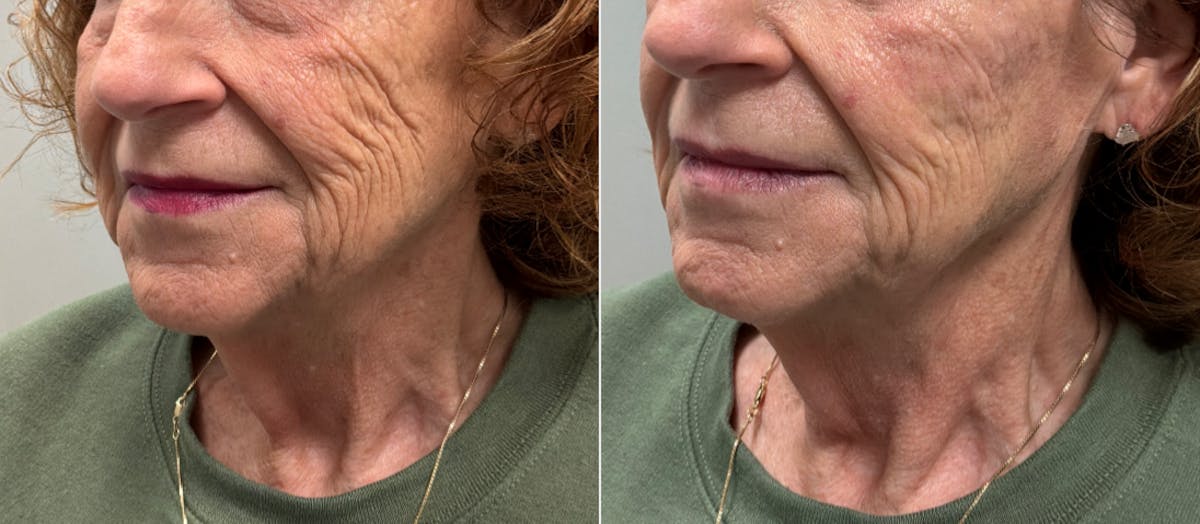 Facial Balancing Before & After Gallery - Patient 661587 - Image 1