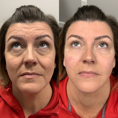 Facial Balancing Before & After Gallery - Patient 191371 - Image 1