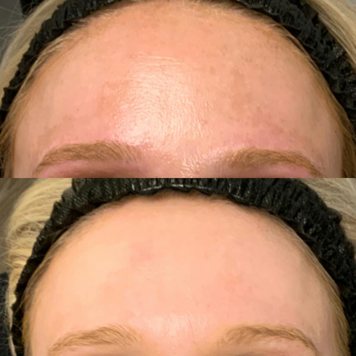 LaseMD Before & After Gallery - Patient 148574 - Image 1