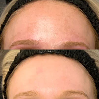 LaseMD Before & After Gallery - Patient 148574 - Image 1