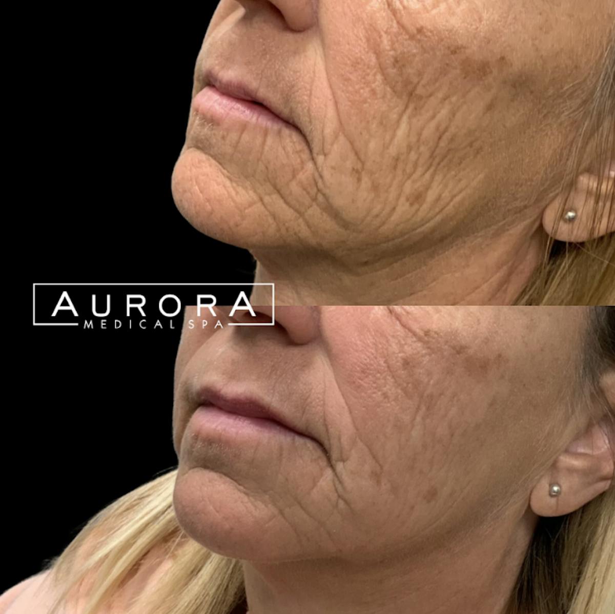Sculptra Before & After Gallery - Patient 242420 - Image 1