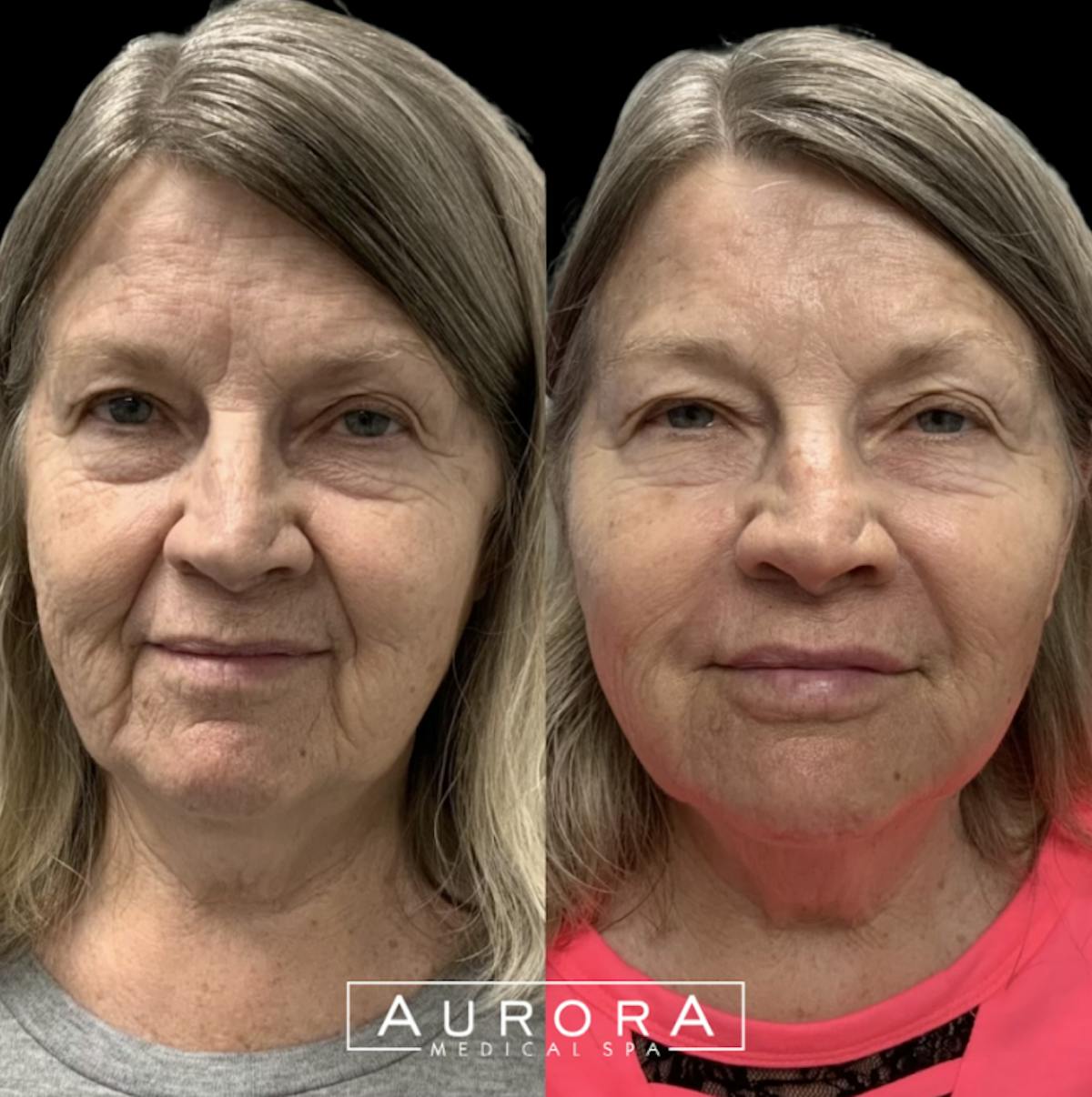 Sculptra Before & After Gallery - Patient 160641 - Image 1