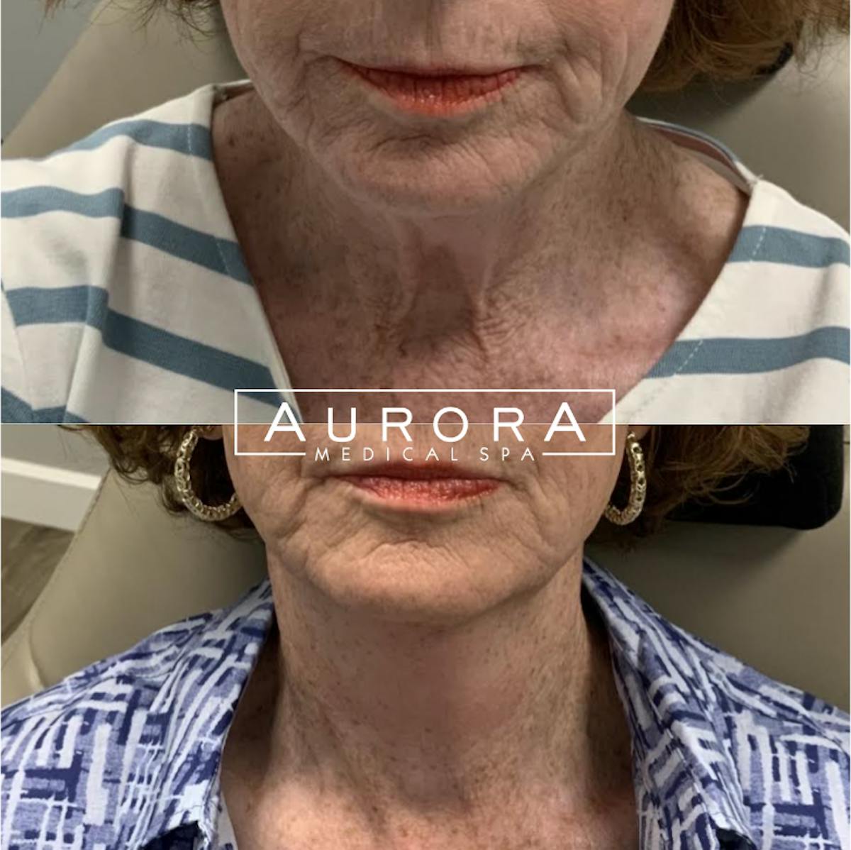 Sculptra Before & After Gallery - Patient 357683 - Image 1