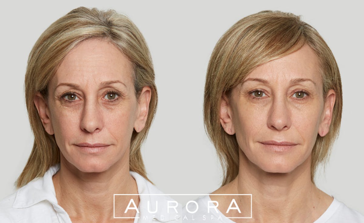 Sculptra Before & After Gallery - Patient 379536 - Image 1