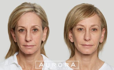 Sculptra Before & After Gallery - Patient 379536 - Image 1