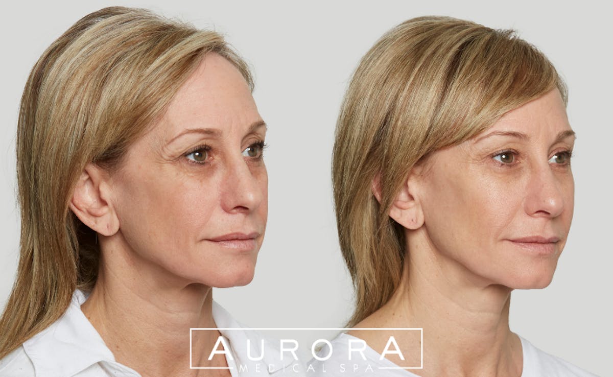 Sculptra Before & After Gallery - Patient 379536 - Image 2