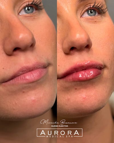 Lip Filler Before & After Gallery - Patient 207280 - Image 1