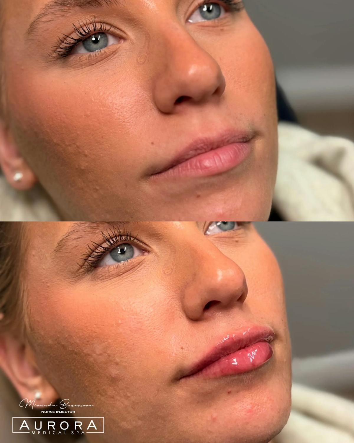 Lip Filler Before & After Gallery - Patient 207280 - Image 2