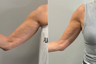 XERF Before & After Gallery - Patient 303507 - Image 1