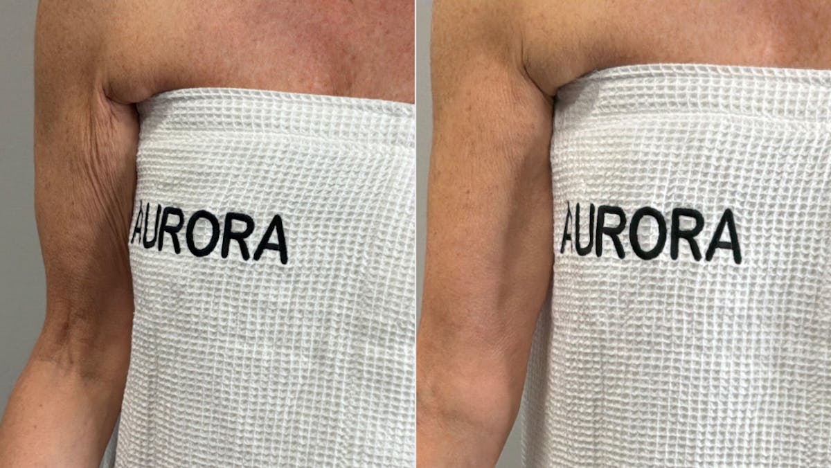 XERF Before & After Gallery - Patient 303507 - Image 2