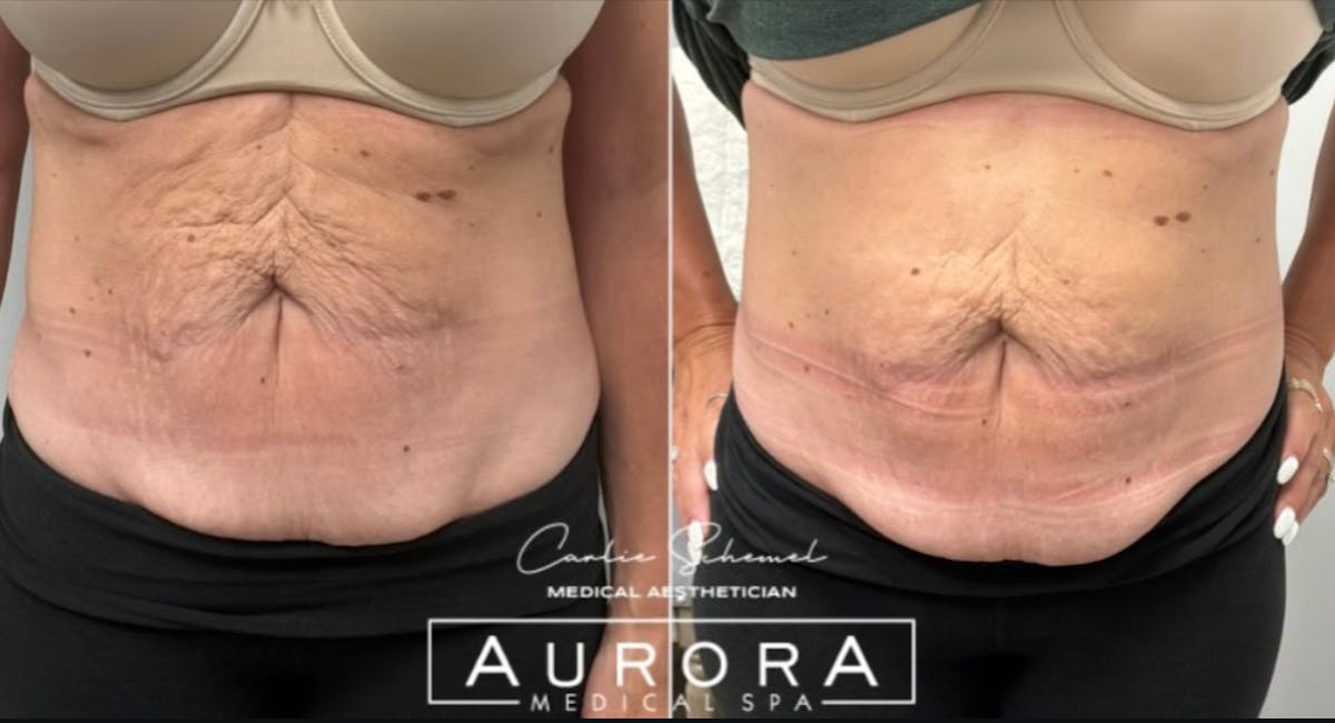 XERF Before & After Gallery - Patient 300630 - Image 1
