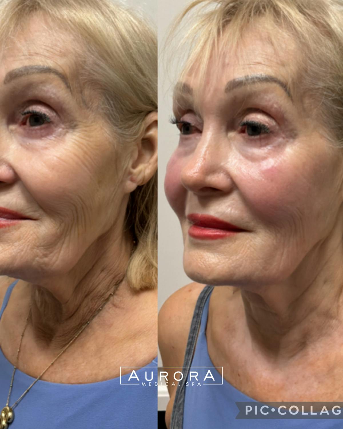 XERF Before & After Gallery - Patient 157722 - Image 1