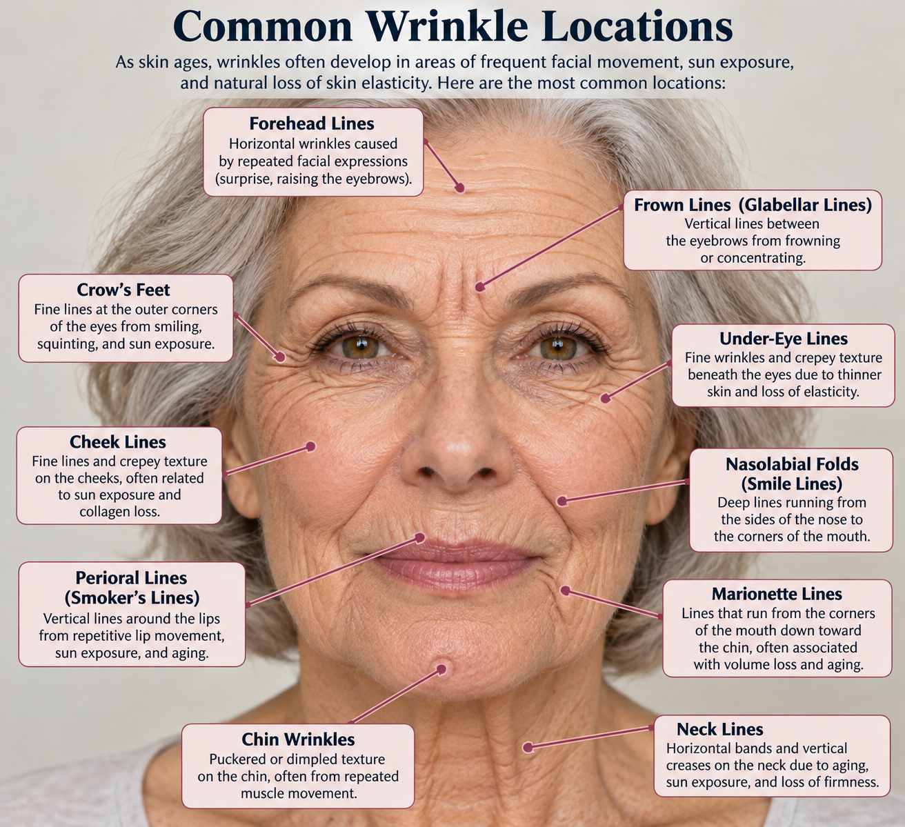Diagram showing common wrinkle locations