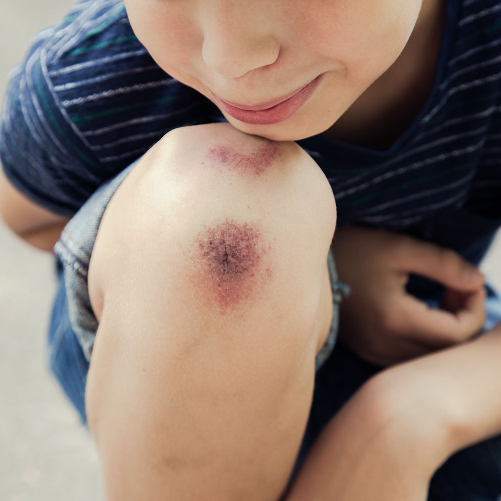 eerste hulp bij ontstoken wonde