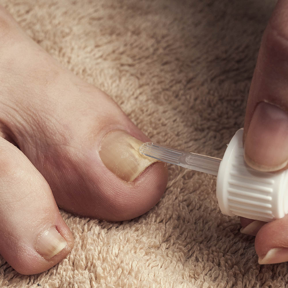 schimmelnagel, voetverzorging