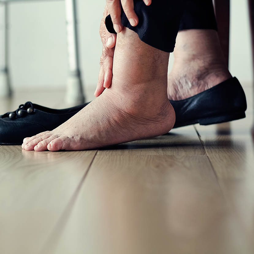 Hier vind je enkele gewoontes die de ontwikkeling van oedeem tegenwerken.